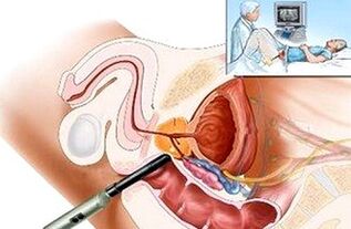 Způsoby diagnostiky prostatitidy