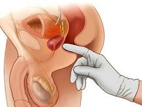 Masáž prostaty pro léčbu prostatitidy u mužů