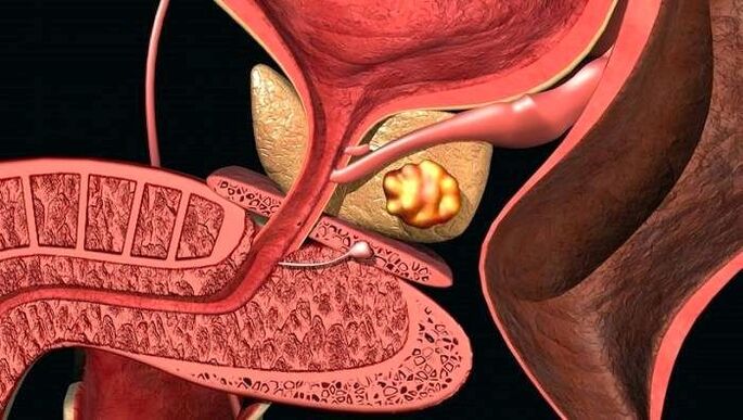 Kamenné usazeniny v prostatě s kalkulózní prostatitidou
