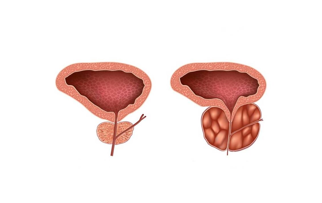 příznaky prostatitidy u mužů