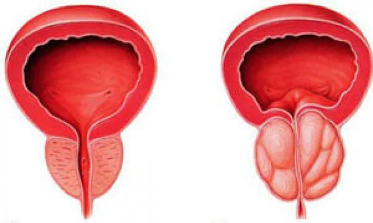 Normální prostata (vlevo) a zanícená chronická prostatitida (vpravo)