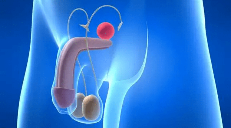 Prostatitida je zánět prostaty u mužů vyžadující komplexní léčbu